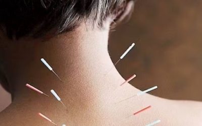 Dry Needling Explained: What to Expect and Who Can Benefit