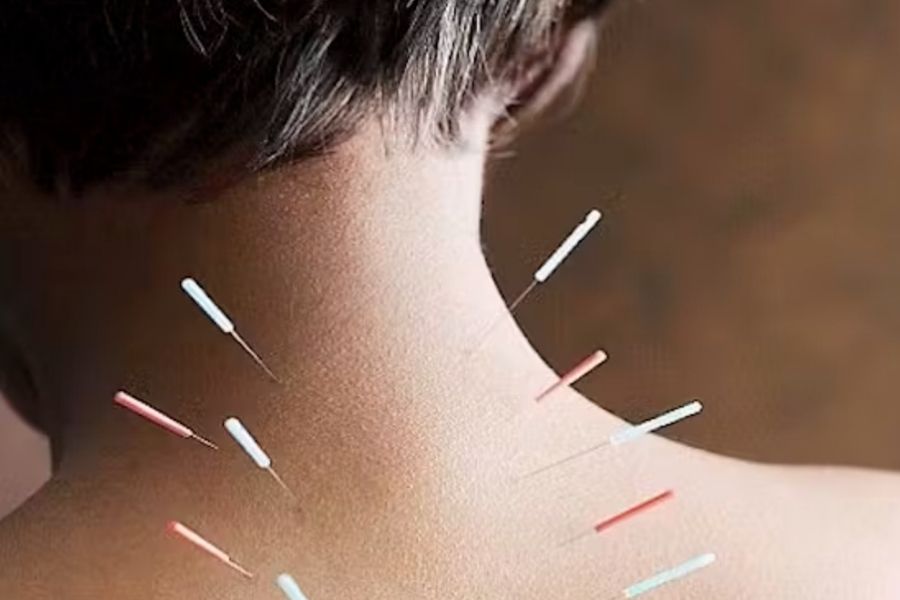 dry-needling-blog-img